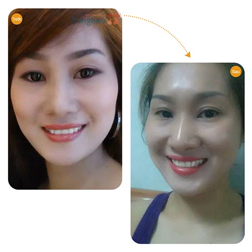 Mắt bị da chùng không còn là nỗi lo của chị ánh Tuyết