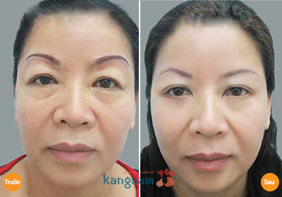 Nâng chân mày có phun xăm