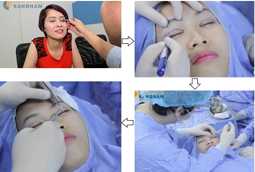 Tìm hiểu kỹ thuật cắt mí mắt bị sụp dưới góc nhìn chuyên gia