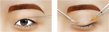 mắt nhiều bọng mỡ mí trên