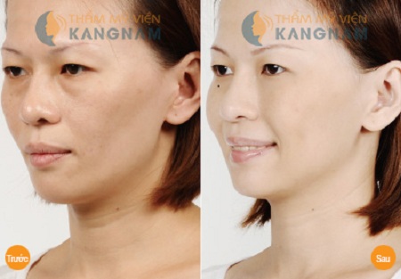 mắt nhiều bọng mỡ mí mắt