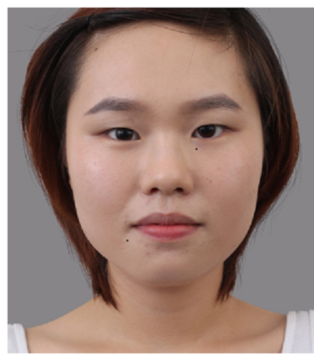 Phẫu thuật chỉnh hình mắt - lấy lại vẻ đẹp cho “cửa sổ tâm hồn”