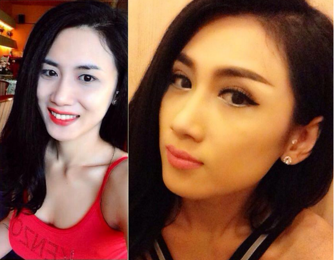 Nâng mí mắt bao nhiêu tiền tại Bệnh viện thẩm mỹ Kangnam? 4