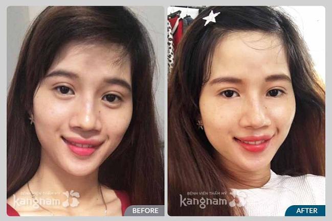 cắt bọng mắt dưới ở đâu đẹp