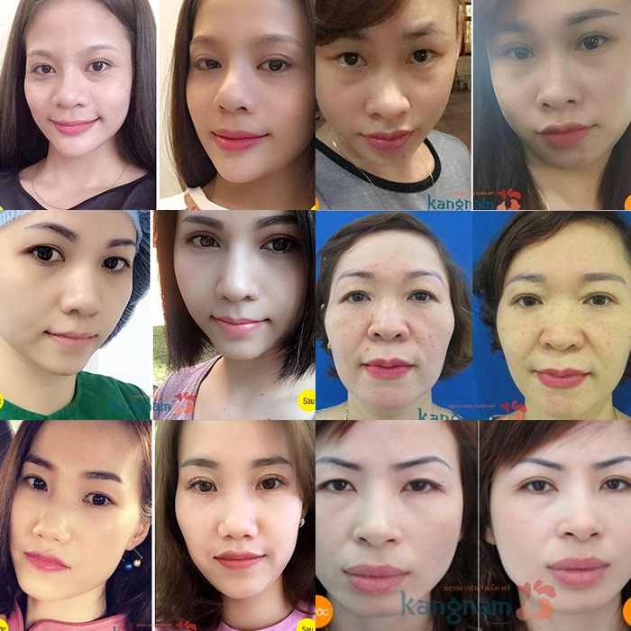 Cắt mí mắt Eyelid là gì?666