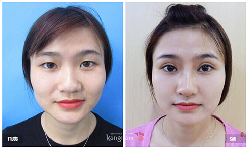 Cắt mí mắt Eyelid là gì?22