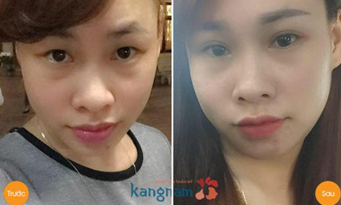 Cắt mí mắt Eyelid là gì?55