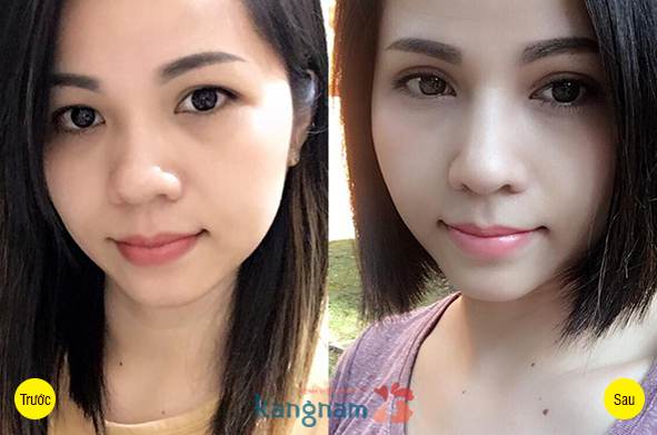 Cắt mí mắt có bị chảy nhiều máu không?2