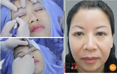 Cắt mí mắt có bị chảy nhiều máu không?1