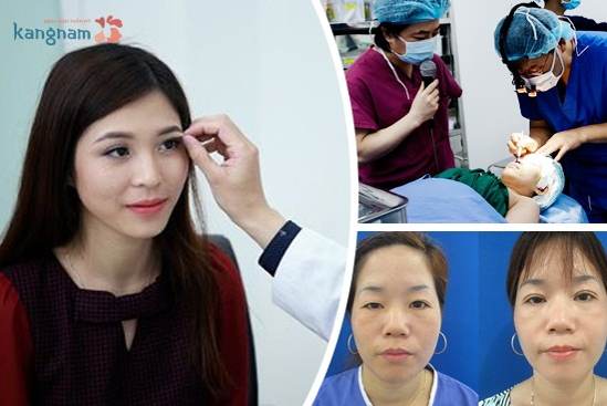 Nâng chân mày bằng chỉ – Mắt đẹp ngay chỉ sau 1 lần thực hiện