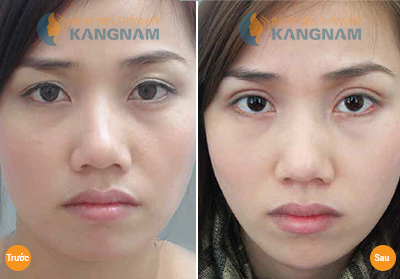 Nâng mí mắt bao nhiêu tiền tại Bệnh viện thẩm mỹ Kangnam? 1