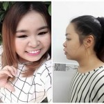 Làm thế nào để 2 mí mắt đều nhau? Tư vấn cho ca sỹ Thái Bảo Trâm