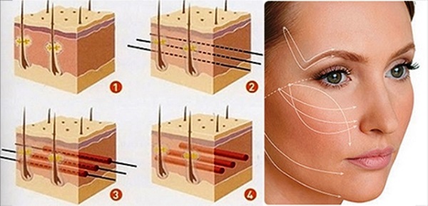 Nâng chân mày bằng chỉ