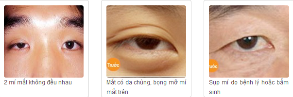 Cắt mí mắt Hàn Quốc áp dụng cho những đối tượng nào?