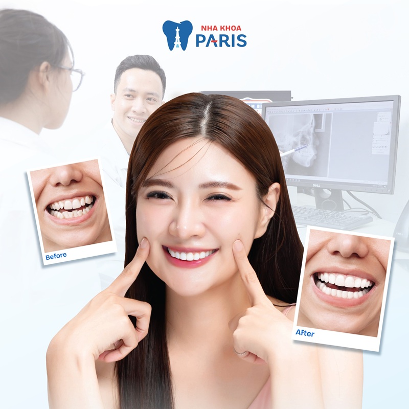 Review  20 nha khoa chuyên niềng răng – Trải nghiệm niềng tại hệ thống Nha khoa Paris
