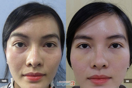 cắt bọng mắt giá bao nhiêu-1