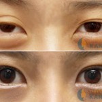 Cắt mí mắt Hàn Quốc sau bao lâu thì mắt đẹp tự nhiên?