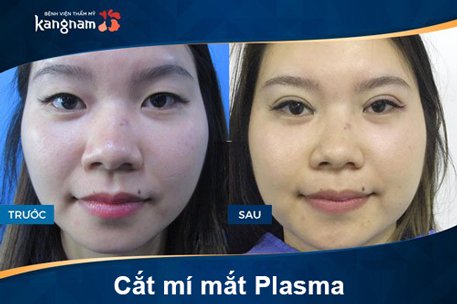 hình ảnh trước sau cắt mí mắt plasma