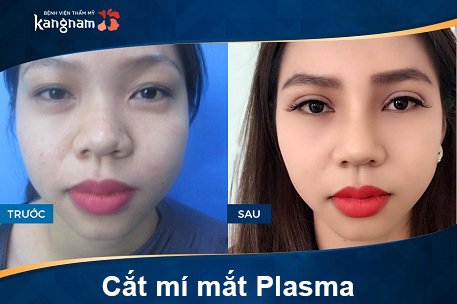 hình ảnh trước và sau cắt mí mắt plasma