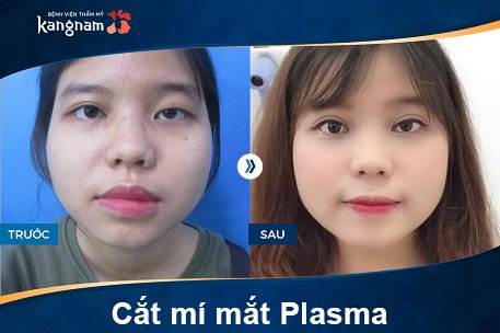 hình ảnh cắt mí plasma