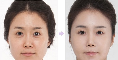 Hút mỡ mắt – giải pháp loại bỏ bọng mỡ mí mắt an toàn, hiệu quả