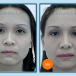 Kết quả cắt mí mắt Hàn Quốc duy trì được bao lâu?