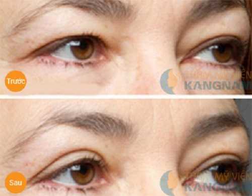 mắt một mí và hai mí
