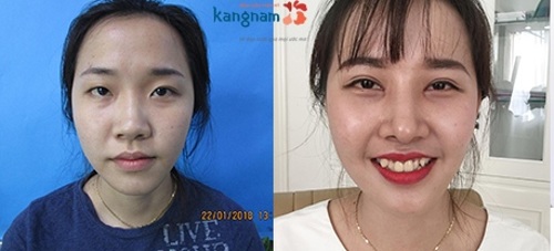 Đến với Kangnam bạn sẽ được thực hiện thẩm mỹ mắt theo 1 quy trình chuẩn