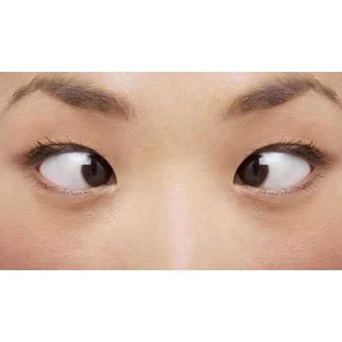 (Mắt lác) Mắt lé là gì? Nguyên nhân và cách chữa mắt lé kim hiệu quả nhất