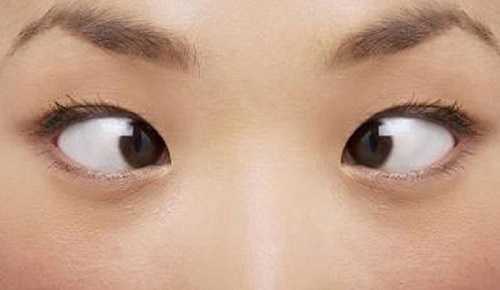 Mắt lác/Mắt lé là gì?Nguyên nhân và cách chữa mắt lé kim HIỆU QUẢ nhất
