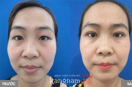 Nâng chân mày bằng botox tạo chân mày cao, trẻ trung đẹp tự nhiên chỉ sau 5 phút Nâng chân mày bằng botox