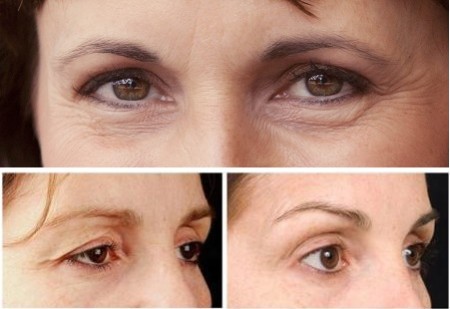 Nên bấm mí hay cắt mí mắt Hàn Quốc để có đôi mắt đẹp?