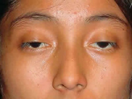 Phẫu thuật mắt sụp mí theo đánh giá của chuyên gia