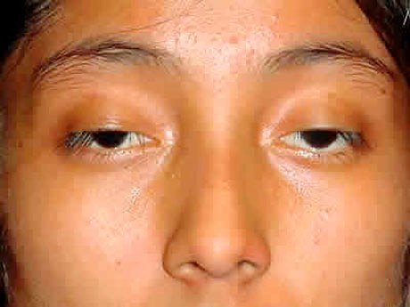 Nên lấy mỡ hay thực hiện cắt mí mắt?