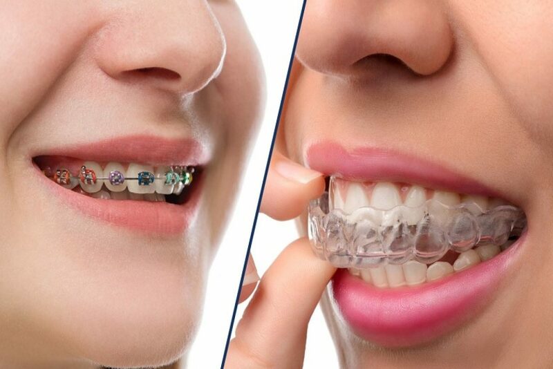 Lựa chọn nha khoa niềng răng uy tín đảm bảo hiệu quả cao