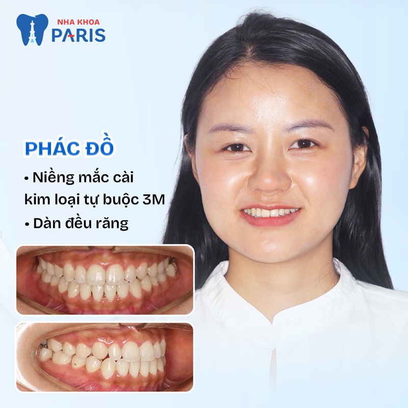 Hình ảnh khách hàng thực hiện niềng răng tại Nha khoa Paris Đà Nẵng 
