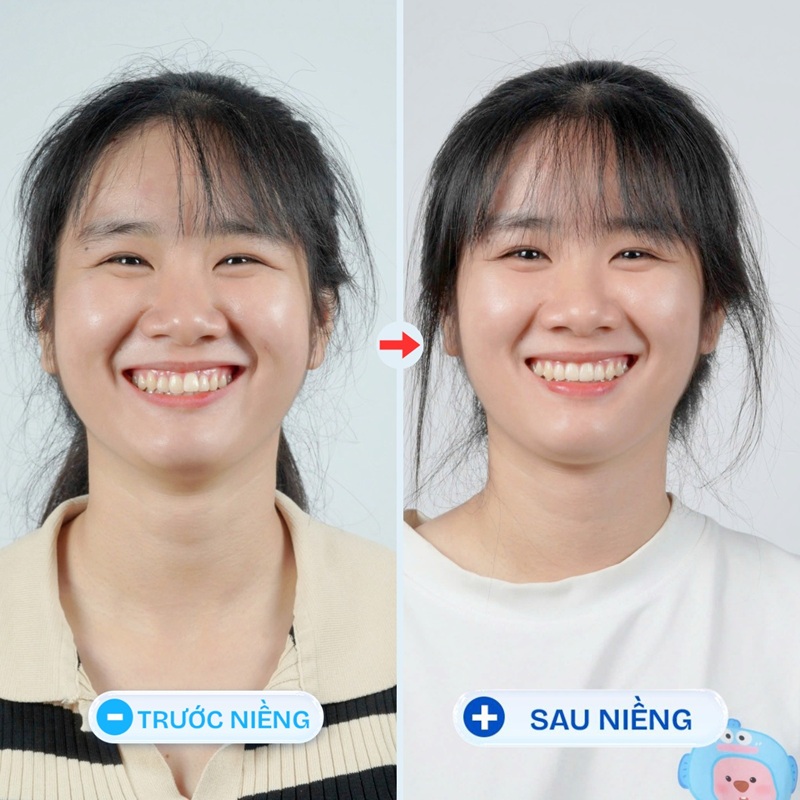 Hình ảnh trước và sau khi niềng răng của khách hàng