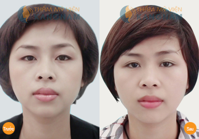 tong-hop-gia-phau-thuat-tham-mat-tai-tmv-kangnam14