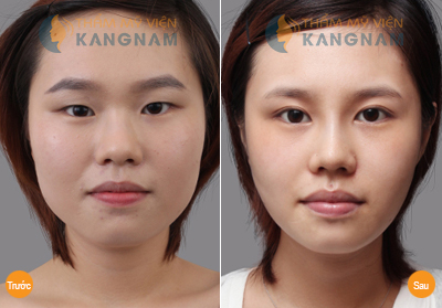 tong-hop-gia-phau-thuat-tham-mat-tai-tmv-kangnam5