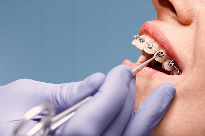 Bác sĩ nhẹ nhàng tận tình điều chỉnh răng niềng