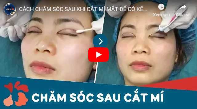 Video bác sĩ hướng dẫn cách chăm sóc mắt sau cắt mí mắt