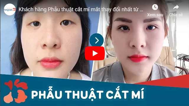 Video khắc phục mắt 1 mí rưỡi, mắt 1 bên 1 mí 1 bên 2 mí