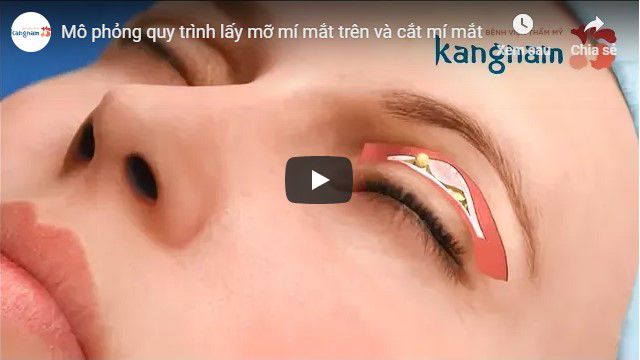 Video quy trình cắt mỡ mí mắt tại BVTM Kangnam